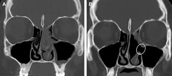 CT Scan Sinus Malad