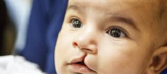 FESS Surgery Image 1